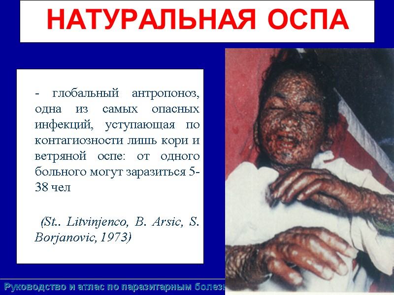 НАТУРАЛЬНАЯ ОСПА          - глобальный антропоноз,